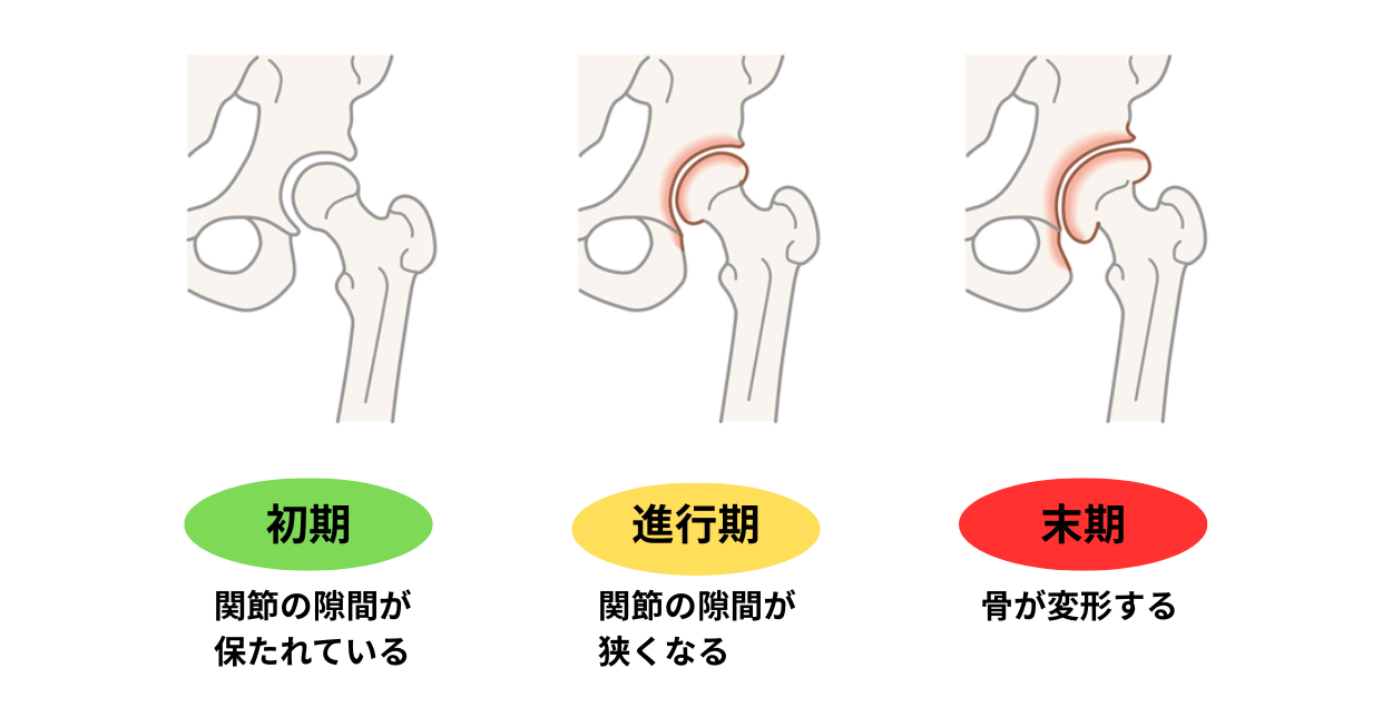 変形性股関節症の図解